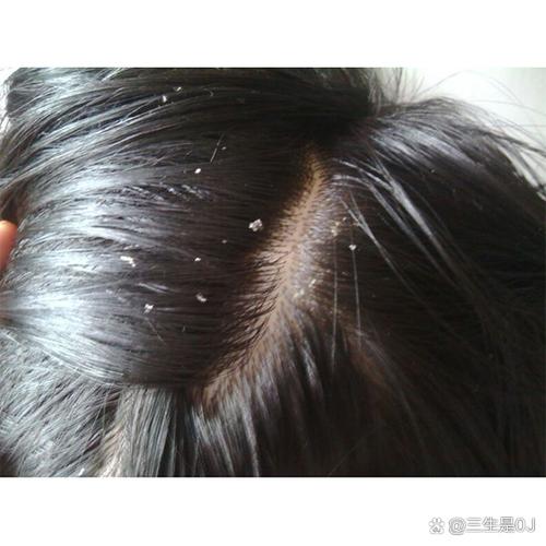 太久不洗头发头皮发黄_头皮发黄?快查查这原因! 太久不洗头发头皮发黄_头皮发黄?快查查这原因!