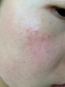 脸一摸化妆品就过敏_屏障修复与预防过敏