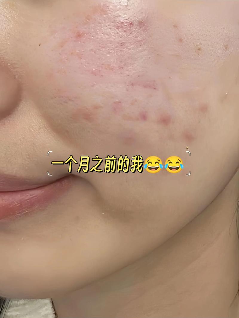 硫磺皂洗脸正确使用方法_油痘肌适用硫磺皂，敏感慎用需注意！