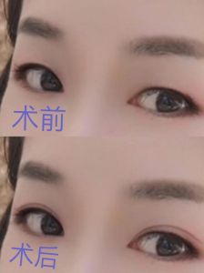 割了双眼皮多久能化妆_双眼皮恢复快慢及化妆要点