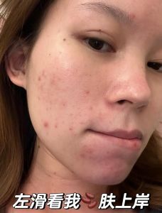 长痘痘时能化妆吗_选对化妆品，饮食清淡，痘痘拜拜