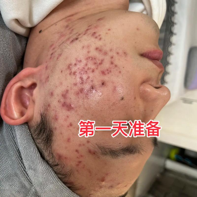 挤完痘痘后多久可以化妆_挤完痘痘别马上化妆，等皮肤好了再涂！