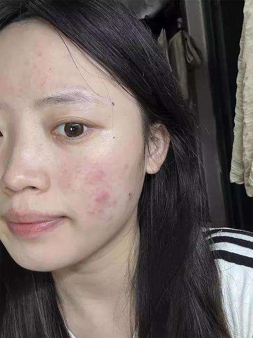 挤过痘痘直接化妆了_挤痘后别马上化妆，等48小时再护理！