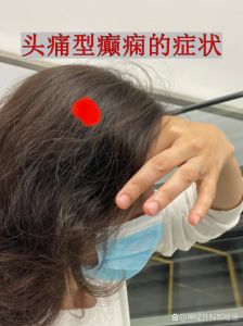 头左半边一摸头发就痛_左半边头皮痛是什么原因？
