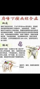 肩峰撞击还能健身吗_肩峰撞击别怕，温和运动来缓解