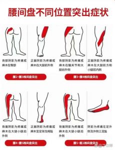 腿弯疼痛部位对照表_肌筋膜炎坐骨神经痛等