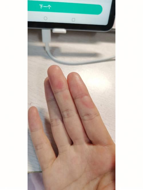 手被卷发棒烫了怎么办_卷发棒烫伤怎么办？速处理防感染！