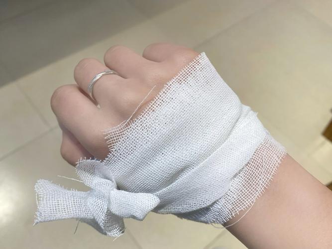 手被卷发棒烫伤了怎么办_卷发棒烫伤手别慌,冷水冲洗防感染 手被卷发棒烫伤了怎么办_卷发棒烫伤手别慌,冷水冲洗防感染