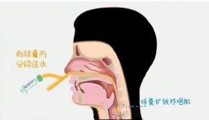 软腭塌陷怎么锻炼恢复_软腭塌陷如何锻炼改善？