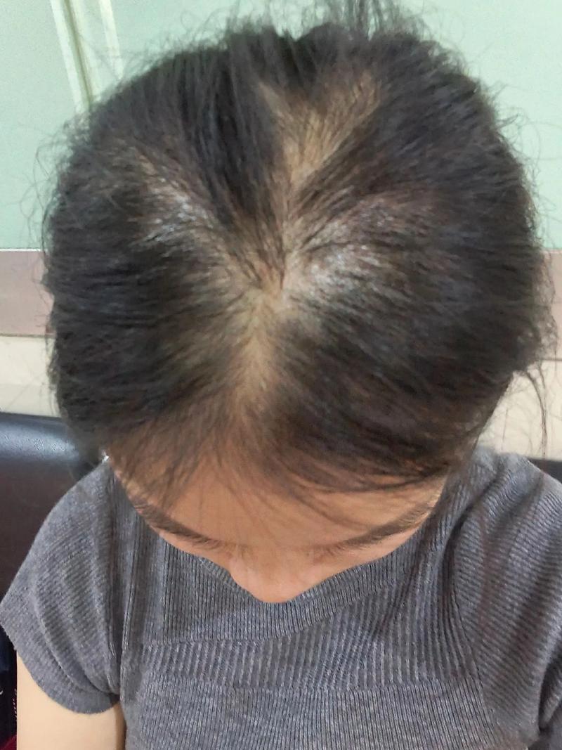 无缘无故少了一块头发_脱发原因多，斑秃真菌缺营养压力大