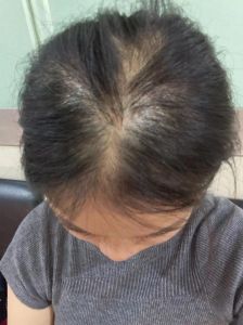 无缘无故少了一块头发_脱发原因多，斑秃真菌缺营养压力大