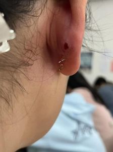 打完耳洞后去洗头发会感染吗_3-7天注意事项