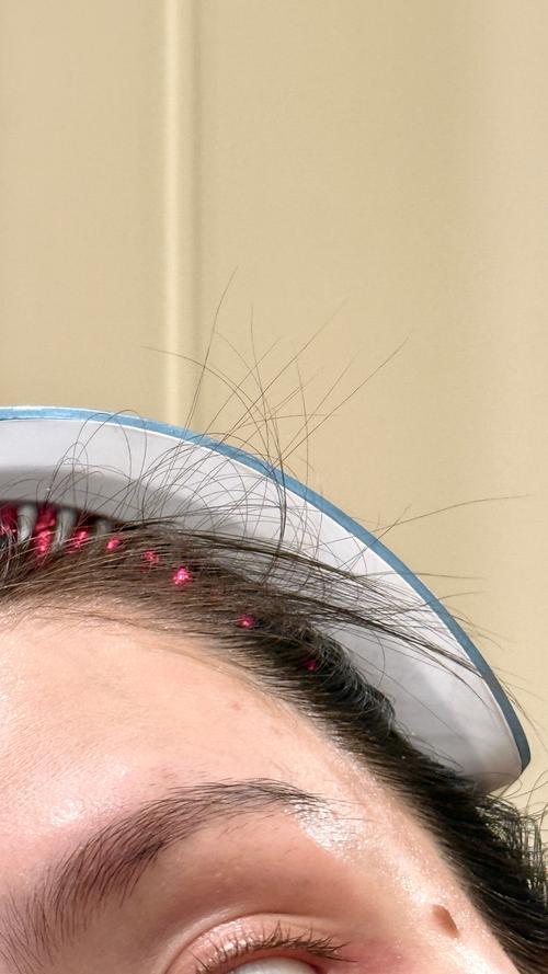 姜片涂发际线会长头发吗_生姜或助生发？刺激头皮需注意