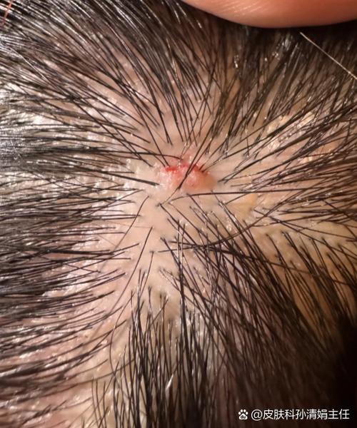 触碰头发根头皮就很痛_头皮痛？烫染太猛发型太紧都可能导致！