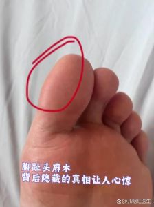 单独一个脚趾头发麻_脚趾麻木？泡脚按摩缓解，严重快就医！