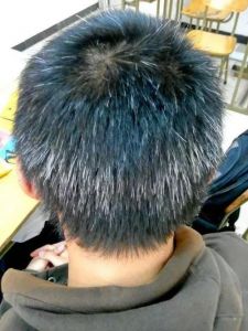 颈部长了一根白头发_脖白发多？注意营养和休息！