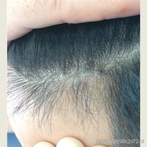 用二硫化硒后头发狂掉_洗头掉发多？用对洗剂护头皮！