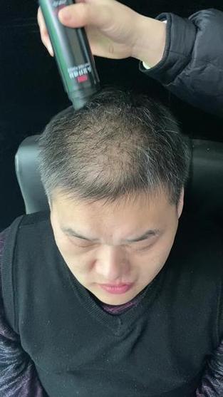 男40岁中间头发稀少_40岁脱发怎么办?关注压力饮食防脱 男40岁中间头发稀少_40岁脱发怎么办?关注压力饮食防脱