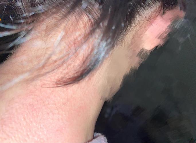 对染发剂过敏还能染头发吗_染发过敏怎么办？