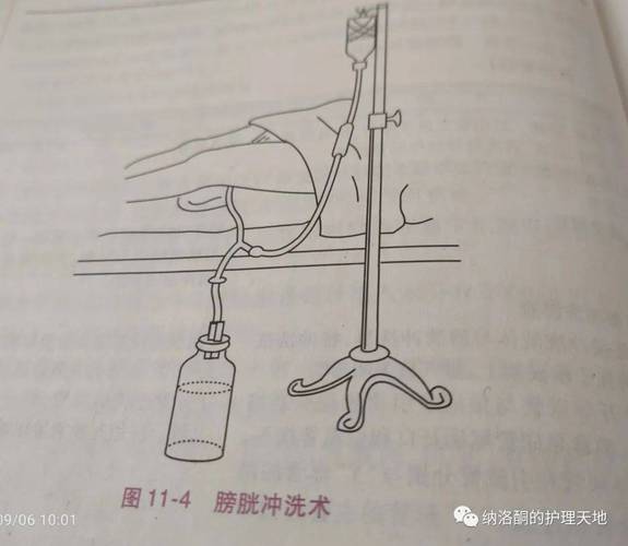 导管子的姿势和方法_选对型号，轻柔插管，确保安全舒适