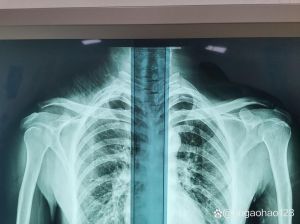 拍肩关节正位片什么姿势_肩正位片拍姿要标准，侧位片患侧紧贴