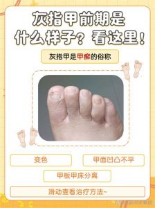 灰指甲是什么颜色_灰指甲颜色多样，从白到黑，防患于未然是关键！